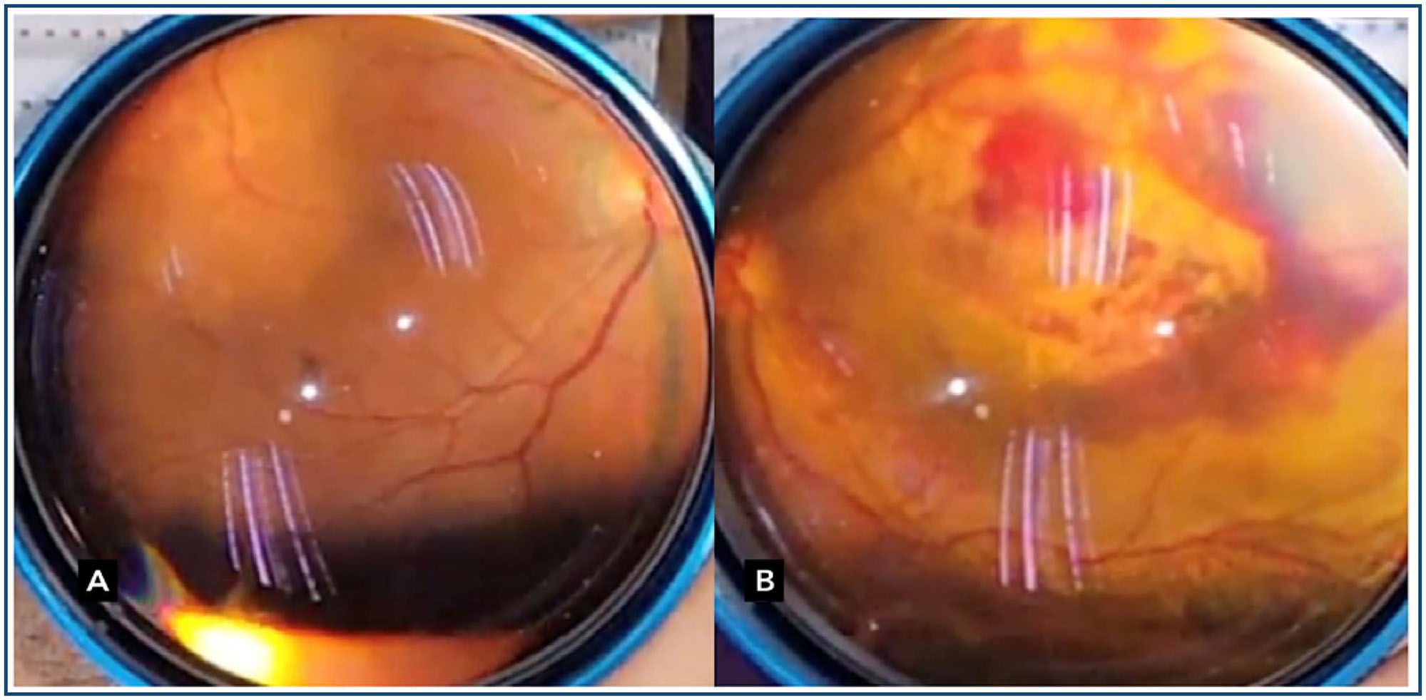 Massa coroidal bilateral como manifestação inicial de câncer de pulmão ...